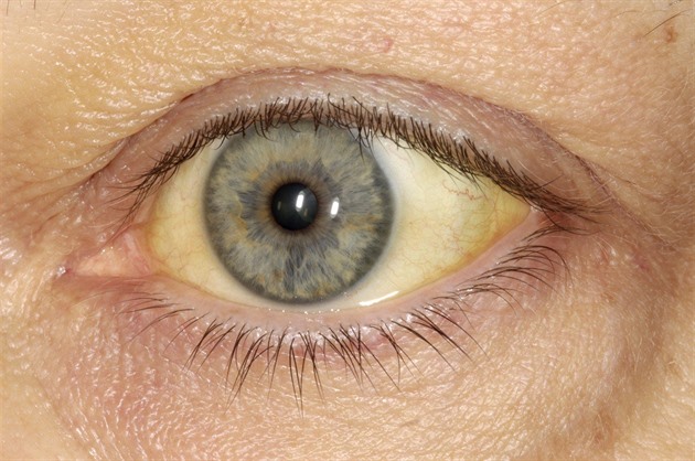 Není žloutenka jako žloutenka. Některou chytíte z masa, o jiné roky nevíte