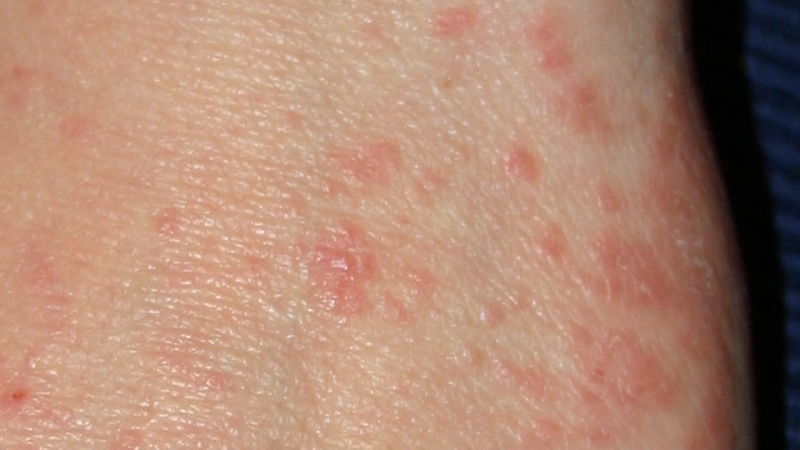 PŘEHLEDNĚ: Svrabem jsou ohroženy všechny skupiny. Jaké jsou příznaky a jak se bránit?